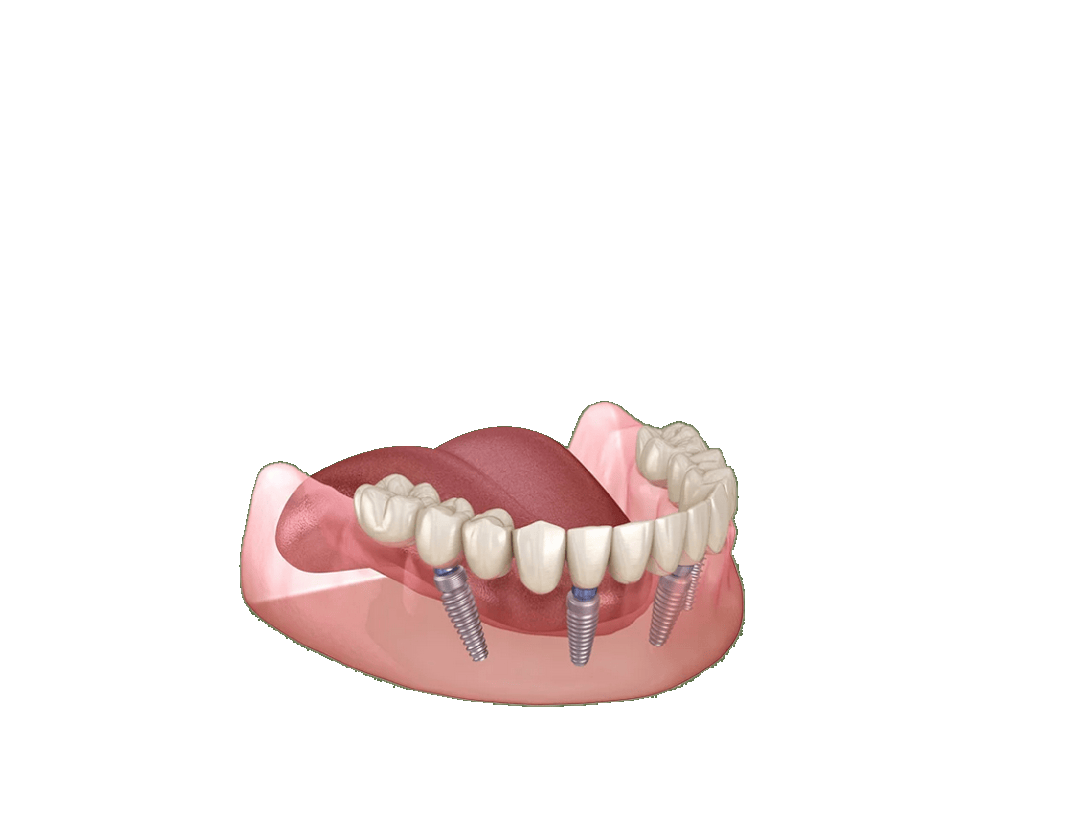 Feste Zähne an einem Tag