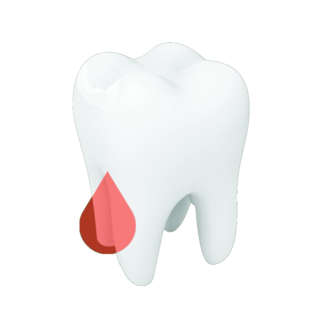Zahnfleisch blutet Parodontitis