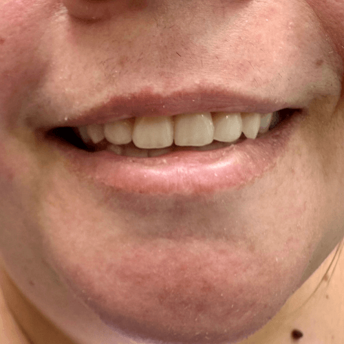 Ergebnis einer Behandlung mit SKY Fast & Fixed bzw. All-on-4 bei Dr. Henninger, glückliche Patientin lächelt mit schönen weißen Zähnen.