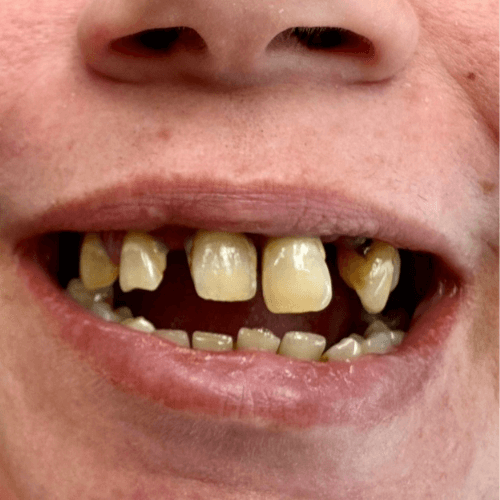 Vorher-Bild einer Patientin mit kaputten und fehlenden Zähnen vor Behandlung mit Zahnimplantaten bei Dr. Henninger.