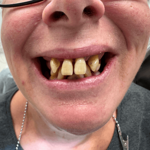 Vorher-Bild einer Patientin vor Behandlung mit Feste Zähne an einem Tag bei Dr. Henninger.
