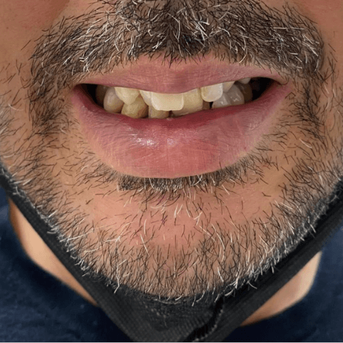 Vorher-Bild eines Patienten vor Implantat-Behandlung bei Spezialist Dr. Henninger.