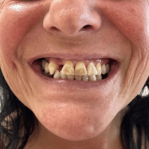 Vorher-Bild einer Patientin vor der All-on-4 Behandlung bei Dr. Henninger.