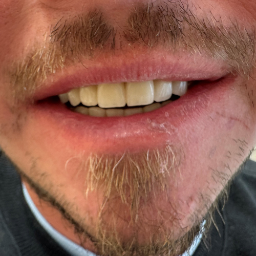 Vorher-Nachher Bilder einer Behandlung mit SKY Fast & Fixed bzw. All-on-4 bei Dr. Henninger, glücklicher Patient lächelt mit schönen weißen Zähnen.