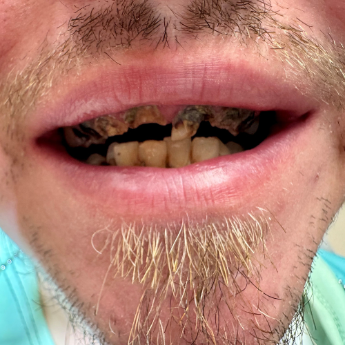 Vorher-Bild eines Patienten vor der All-on-4 Behandlung bei Dr. Henninger.